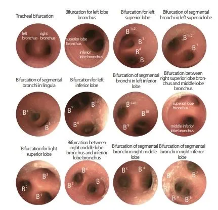 Difficult Airway Management Bronchoscopy Model